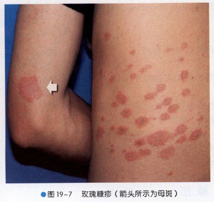 玫瑰糠疹:究竟是什么"鬼"?-郭波主治医师-爱问医生