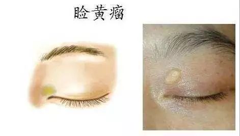 的長方形或多角形丘疹和斑塊,長約2-30mm; 好發於兩側上眼瞼內眥部