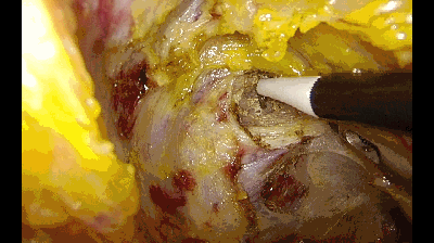 腹腔镜十八般武器之---离别钩