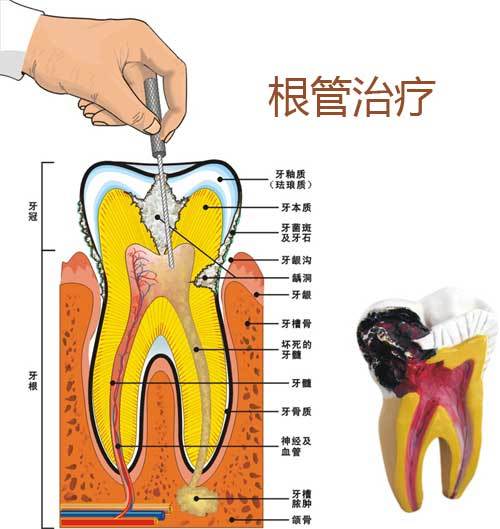 杀神经是牙髓失活术的通俗说法