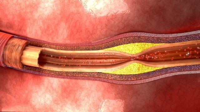 辟谣:发现颈动脉斑块就得吃药?医生:这件事很重要!