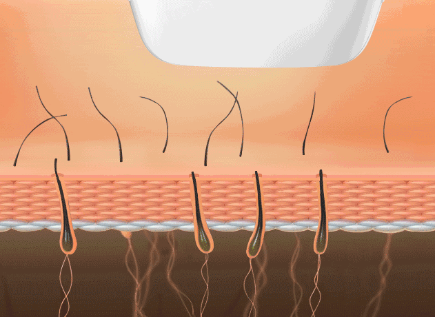 脱毛所用到的激光,目标靶色基就是毛囊中的黑色素.