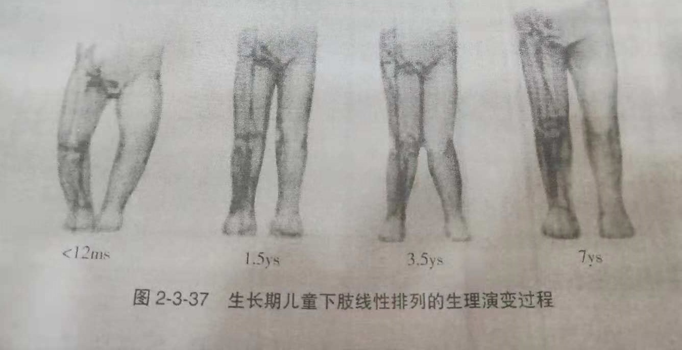 宝宝膝盖内翻图片图片