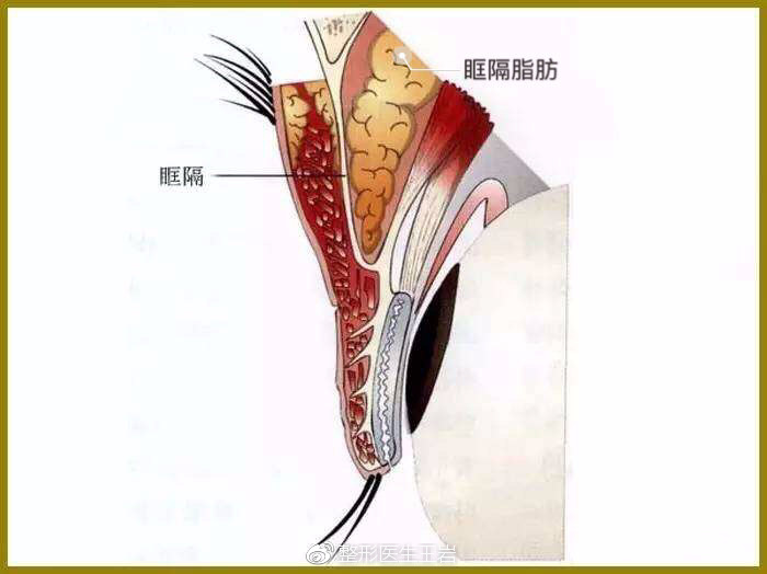 眶隔脂肪在哪里图片