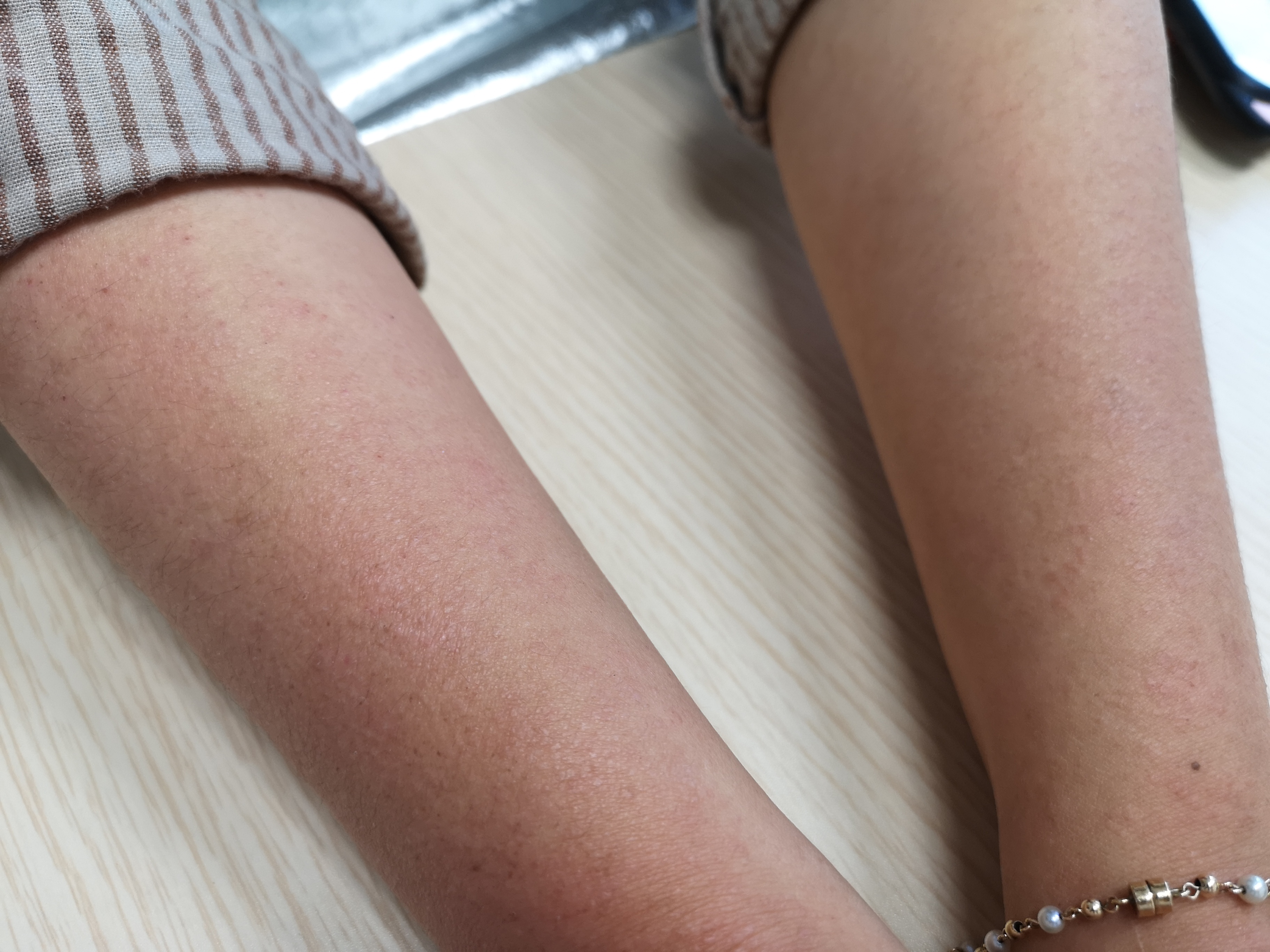 三,光敏性皮肤病