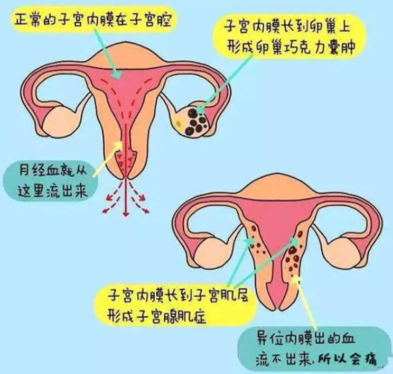 子宫肌腺症是什么病严重吗如何治疗
