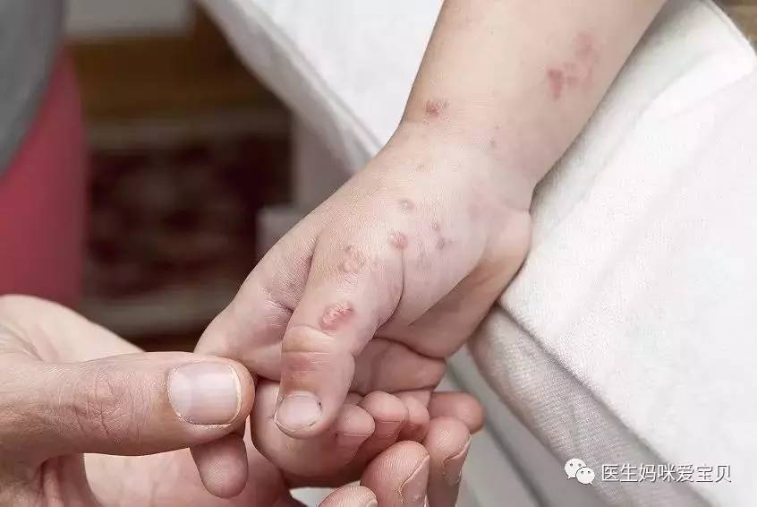 手足口病不用怕,最全介绍在这里!(含家长如何识别重症)