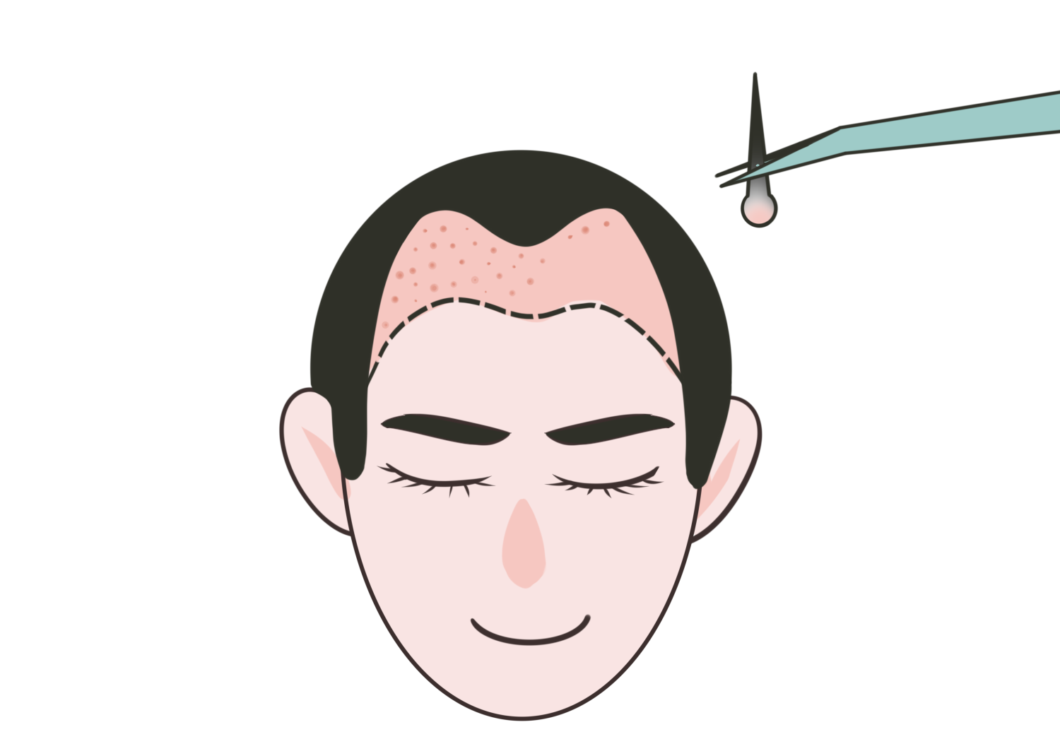 北京科發(fā)源醫(yī)療美容植發(fā)怎么樣？真人案例在這里