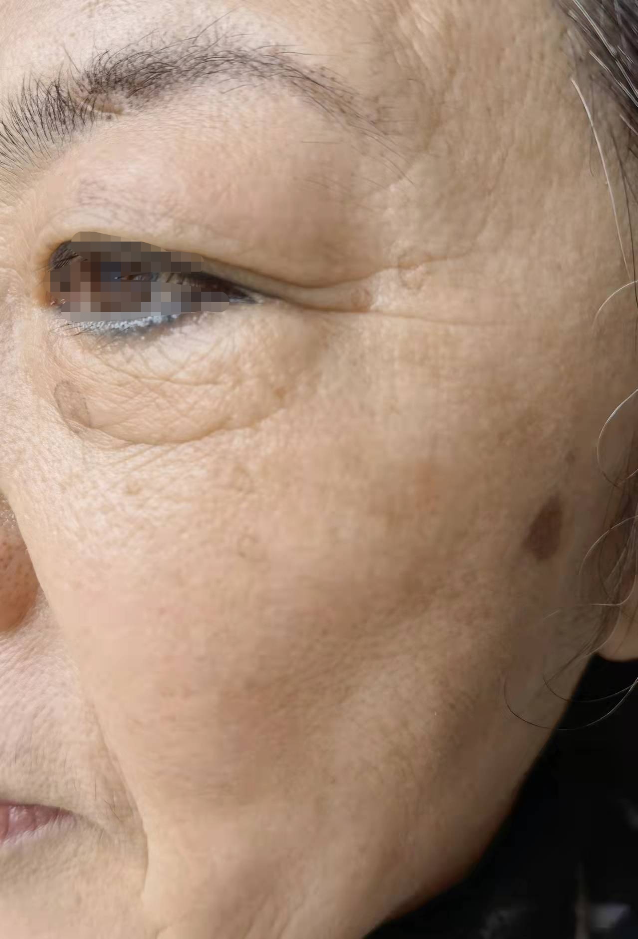 面部色斑的分类及治疗 - 知乎