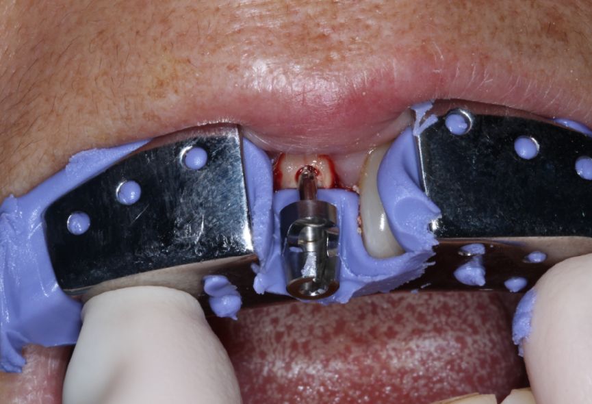 微创拔牙和即刻种植美学区种植修复的经典