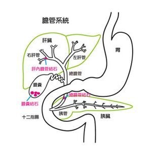 上腹不适,当结石阻塞胆道并继发感染时,可表现为典型的charcot三联征