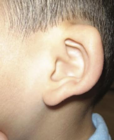 耳朵卷曲原来是杯状耳!如何治疗?