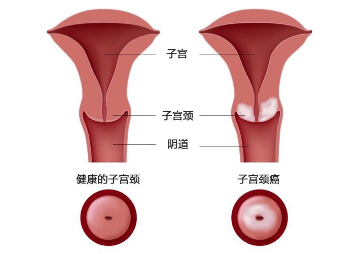 宫颈囊肿可以单发,也可以多发