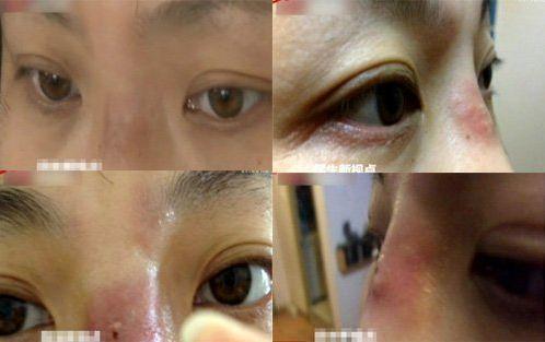 cfda认证:玻尿酸隶属医疗器械 这才是它的真身