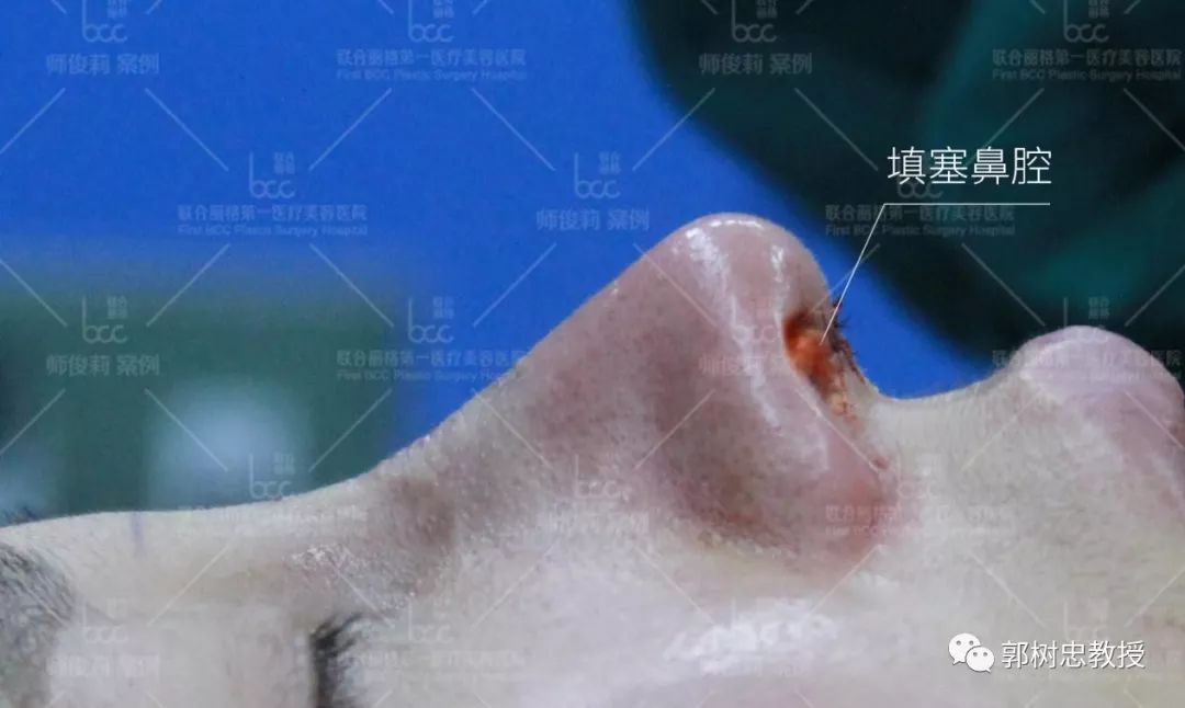 鼻腔分泌物进入伤口之外,最重要的作用是压迫止血和维持鼻子的外形