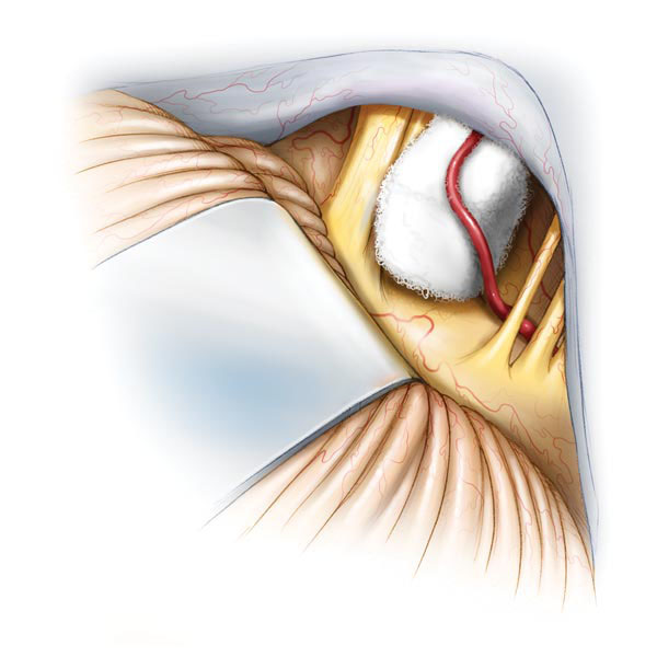 面肌痉挛显微血管减压术治疗前后对比示意图