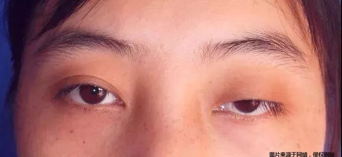 花100万整形,效果不太好?