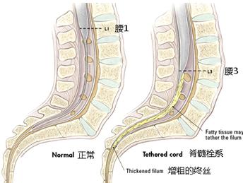 脊髓栓系综合征的症状图片