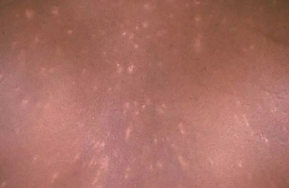 梅毒性白斑初期图片图片