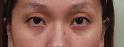 ▼眼窝凹陷▼眼窝无凹陷我们来看看同一个女性,没有眼窝凹陷和有眼窝