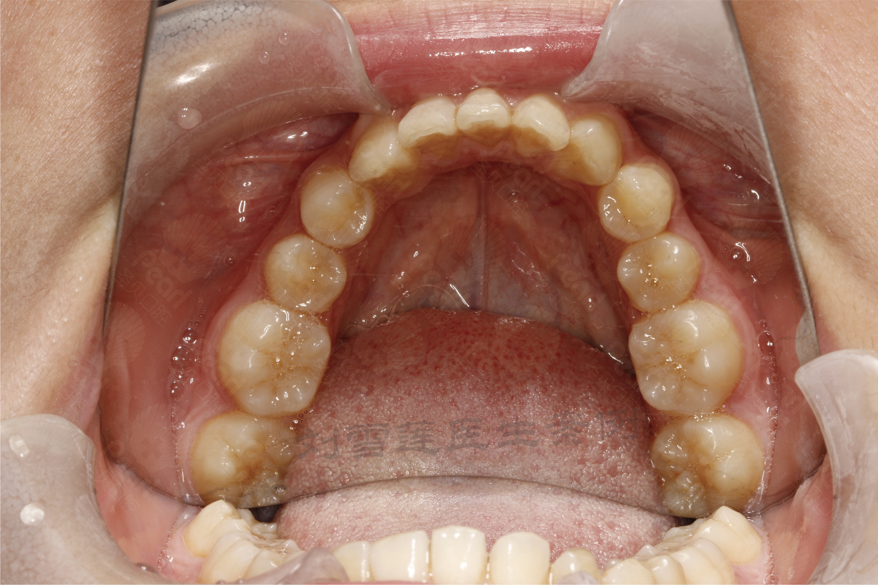 上颌6牙齿的颌面图片图片