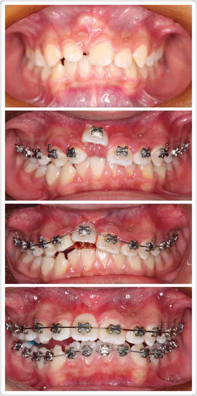 八个月,右上切牙终于归位,还需要把转矩再调整好,收一下覆盖,13岁的小