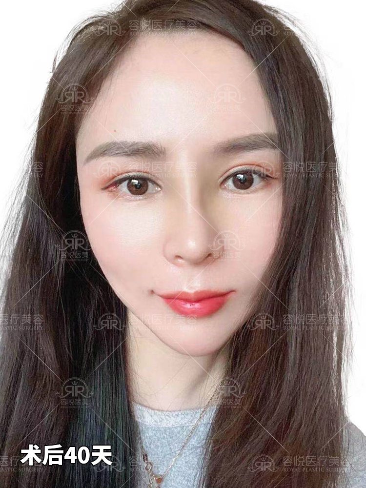 鼻基底面部塑形整容如换头u脸变v脸美女