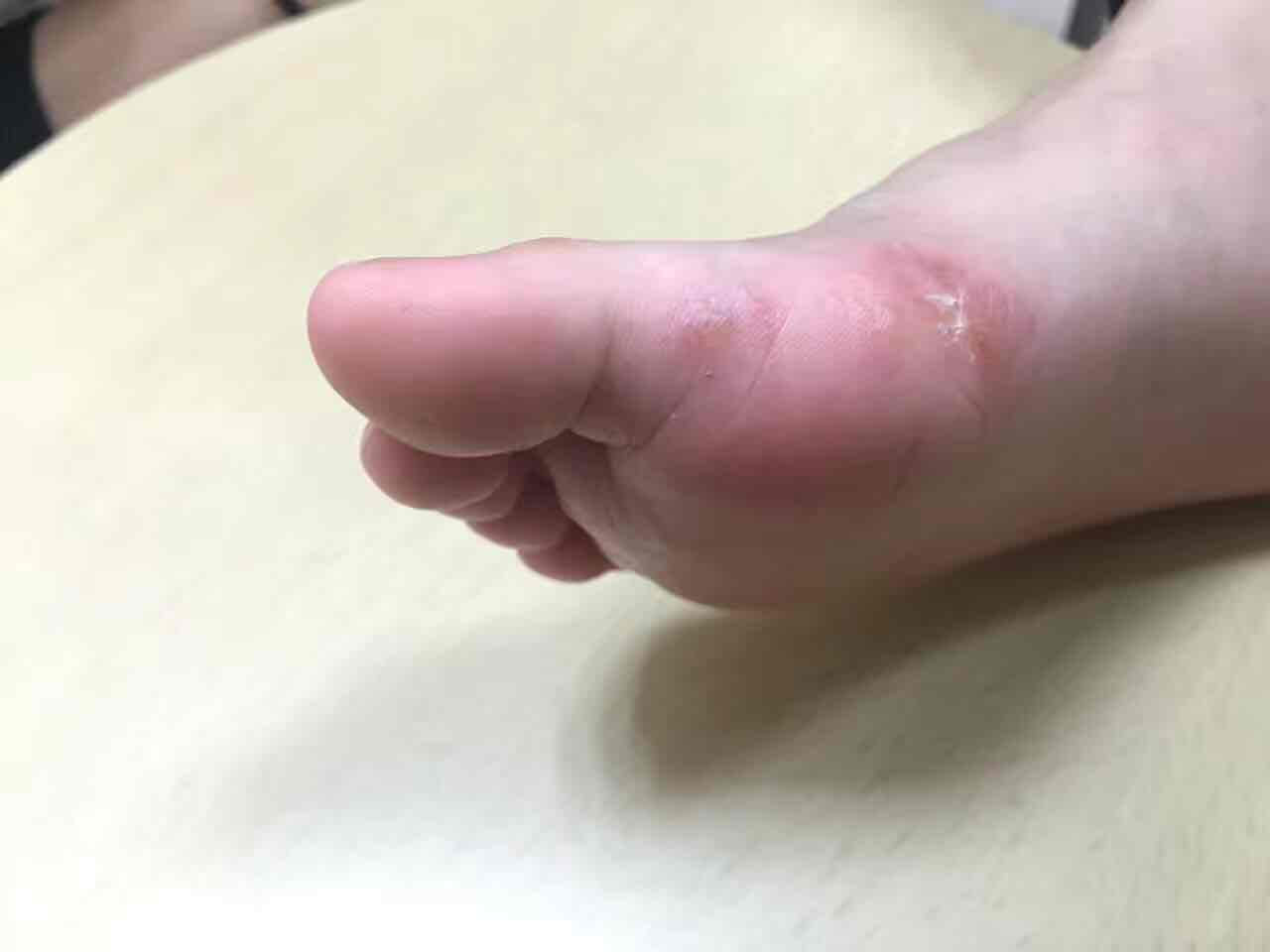 tips:足癣,香港脚,属真菌感染.春夏热,南方潮,鞋里湿,真菌乐!