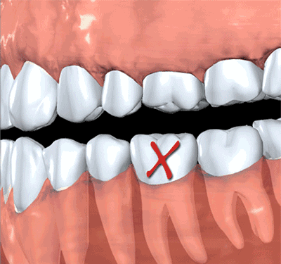 缺牙后,邻牙由于失去支撑,会出现移位,倾斜,伸长,最终其余健康牙齿也