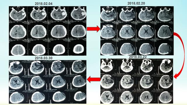 這是患者的頭部ct進展