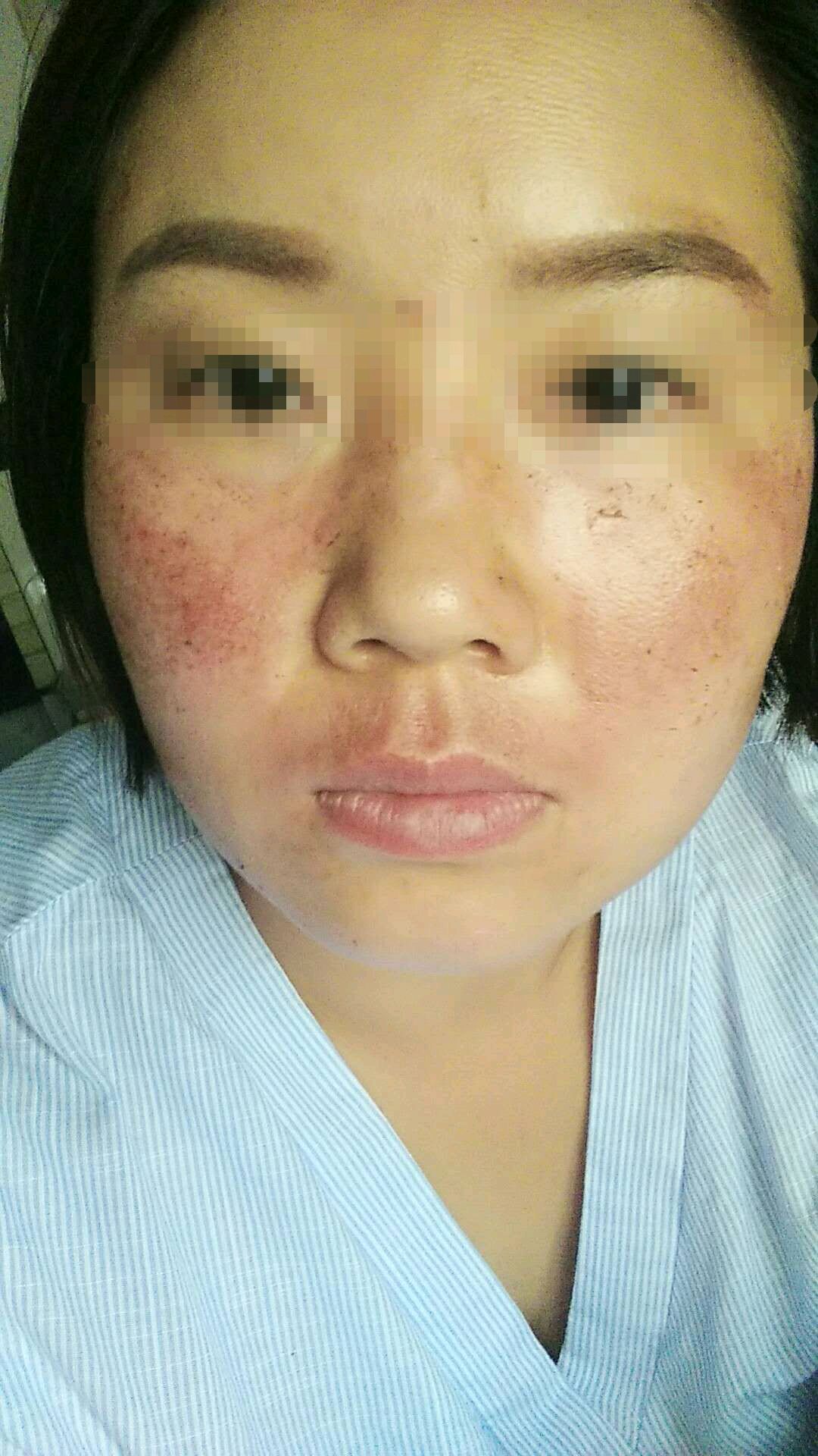 去年冬天就诊,血管优势型黄褐斑为主,让她口服氨甲环酸,配合氨甲环酸
