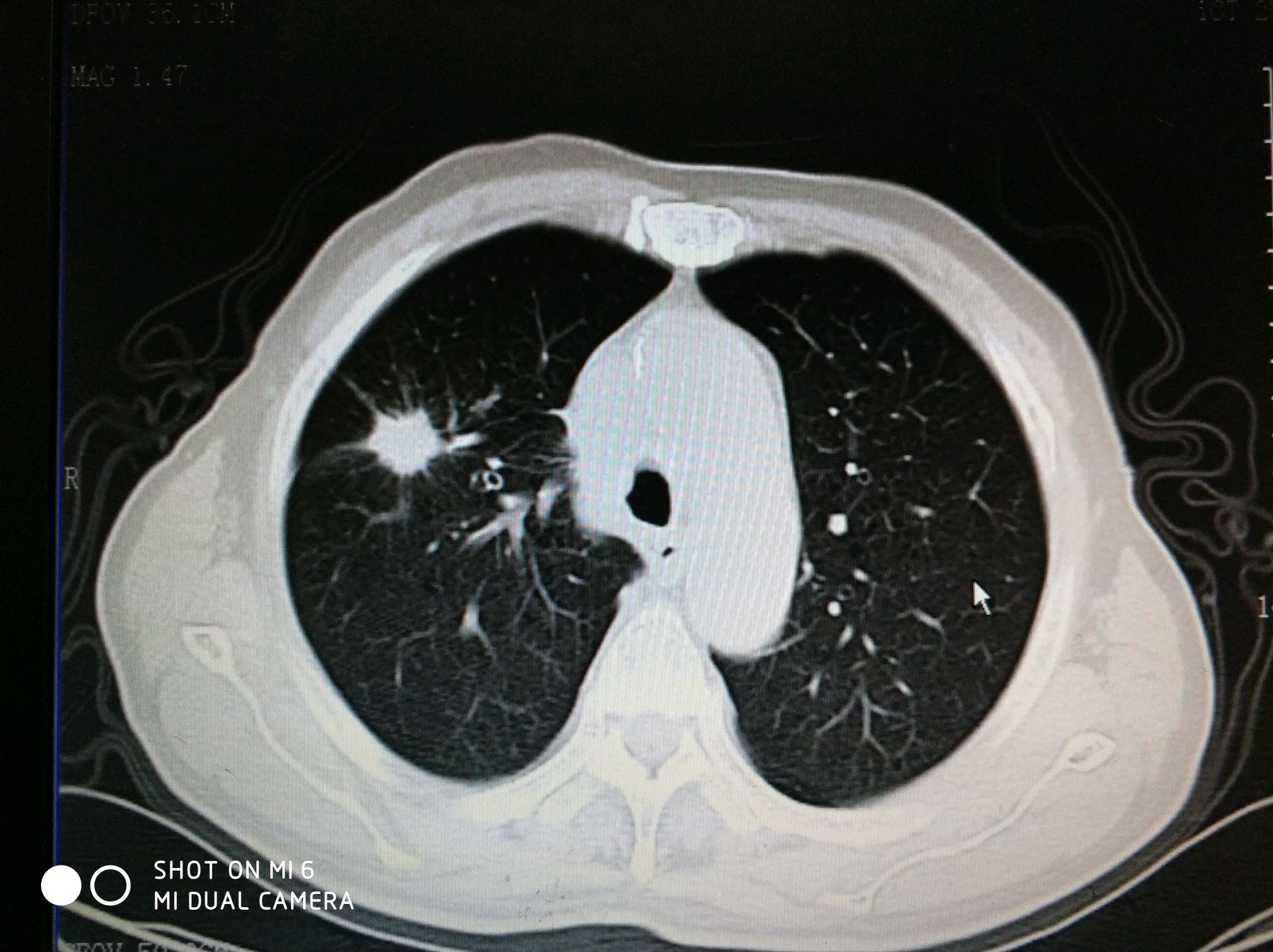 肺鳞癌ct图片