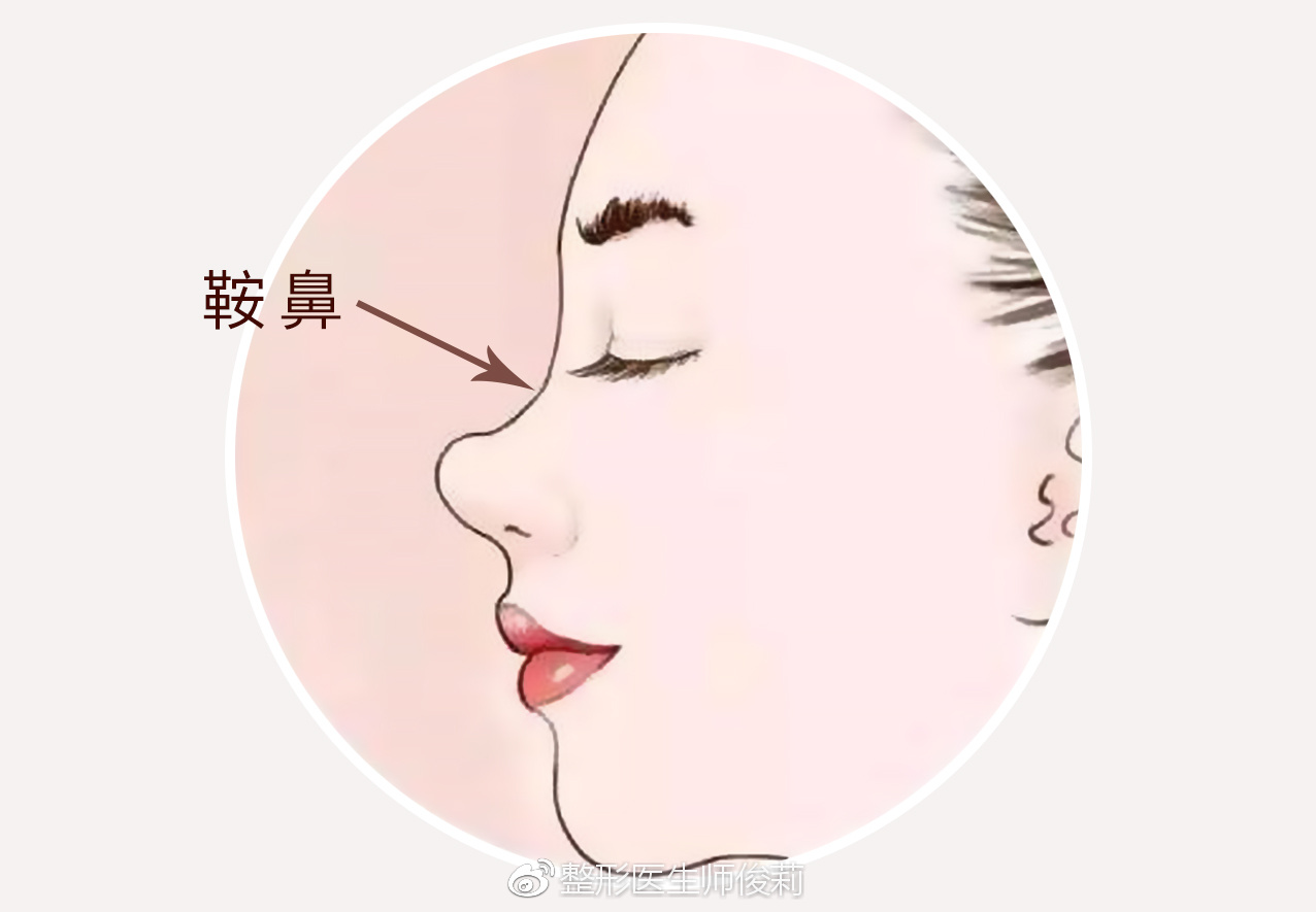 她的鼻子基础条件比较差,属于典型的鞍鼻,我通常管这种鼻子叫"南方鼻"