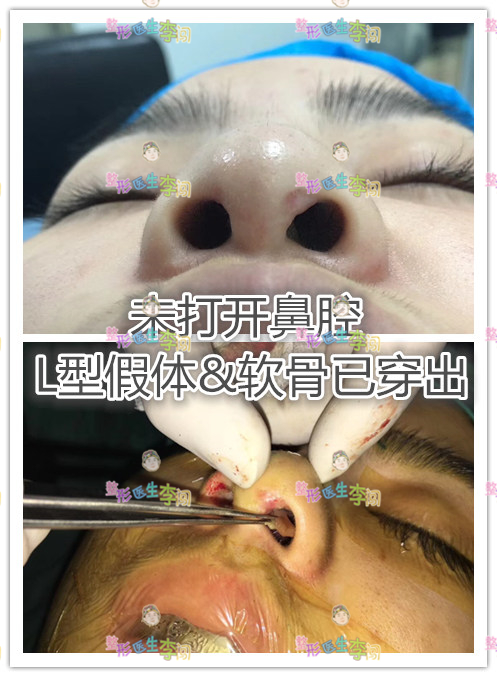 因为将塌鼻子垫高,相对要用更厚的假体,那么皮肤就很容易被