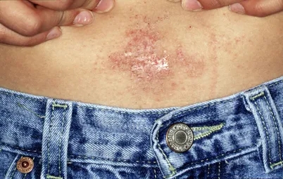 天啊穿衣服戴饰品居然会引发皮肤问题