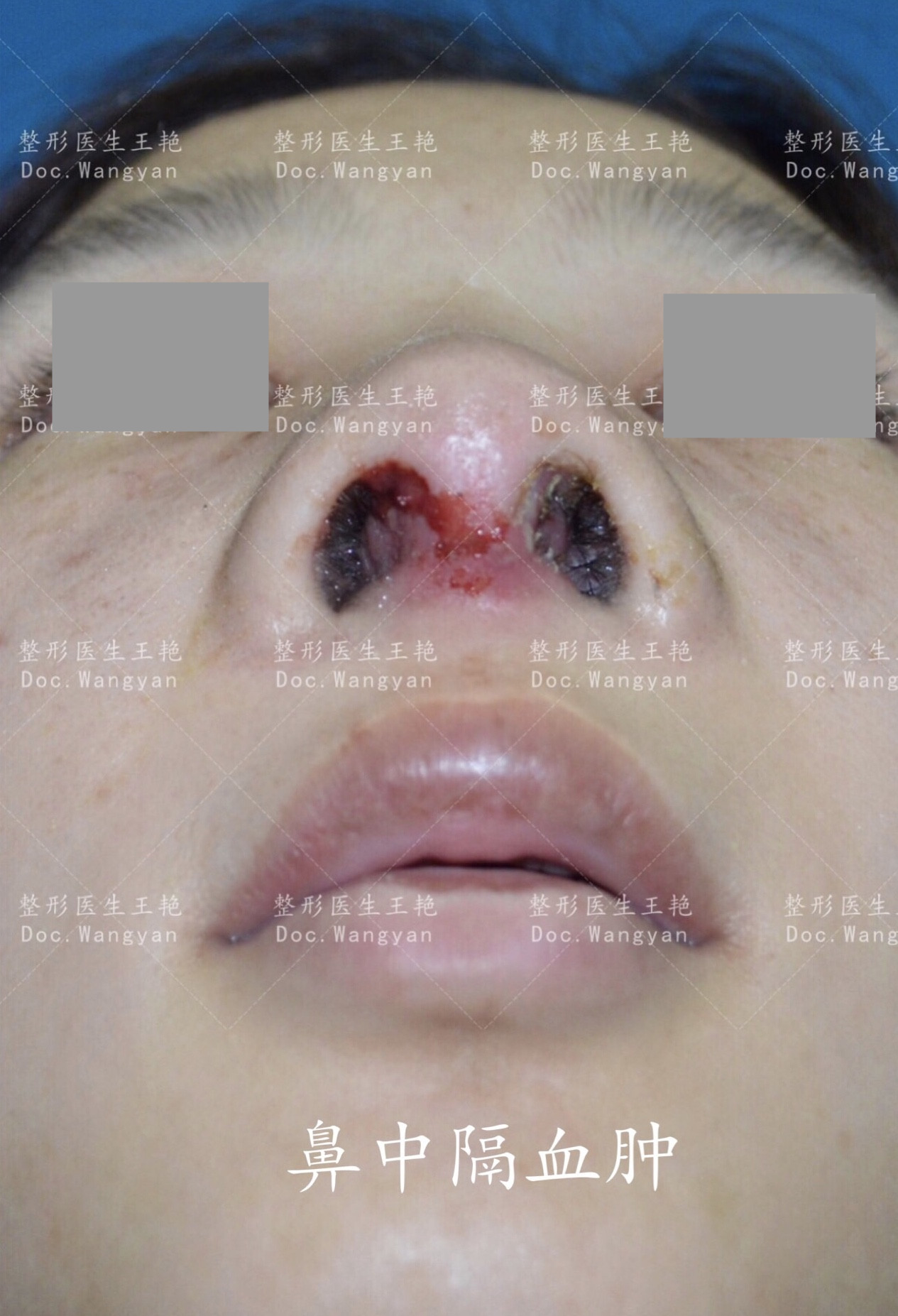 鼻中隔术后血肿图片图片