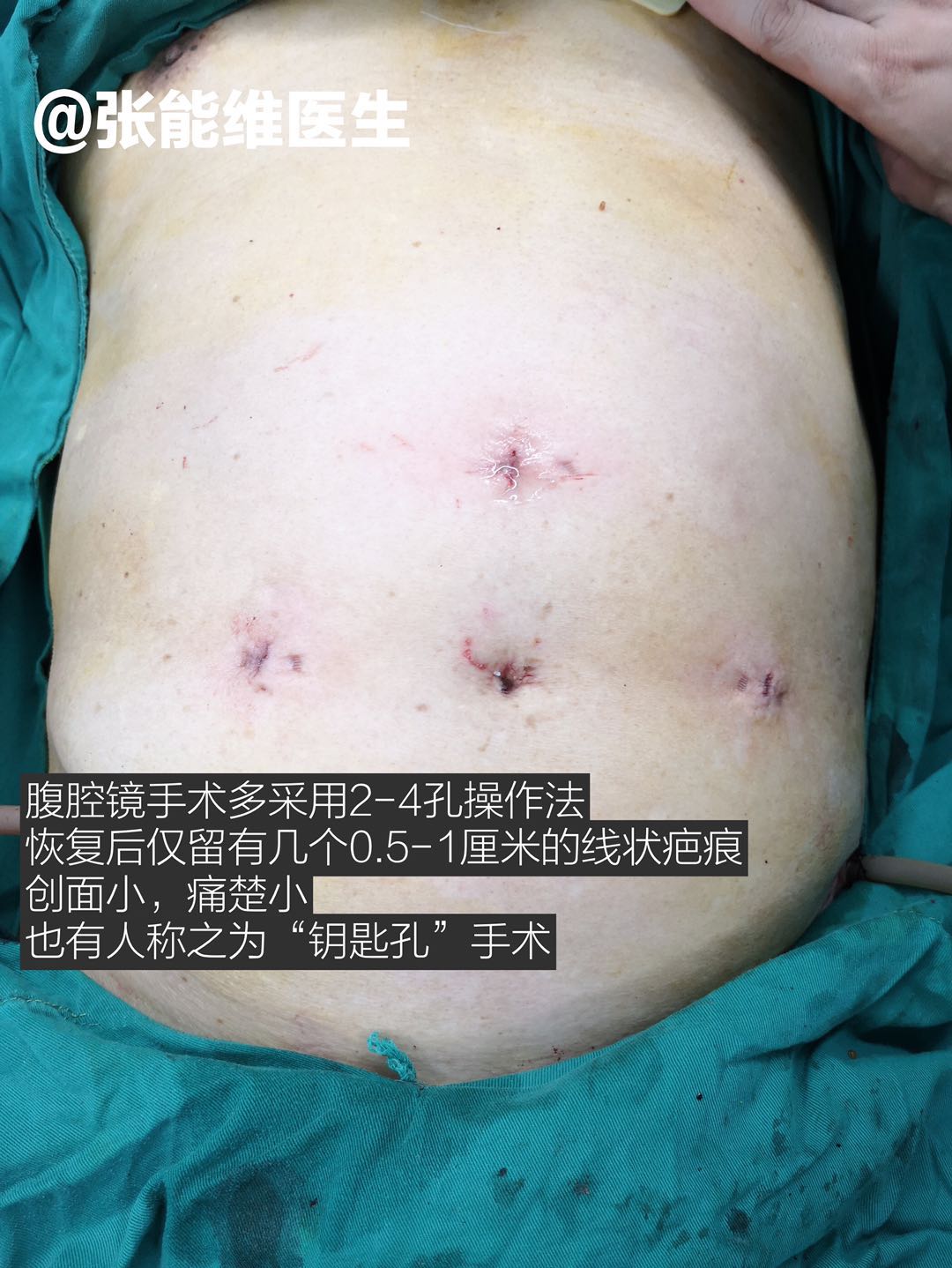 病例分享:腹腔镜下乙状结肠癌 超低位直肠癌手术