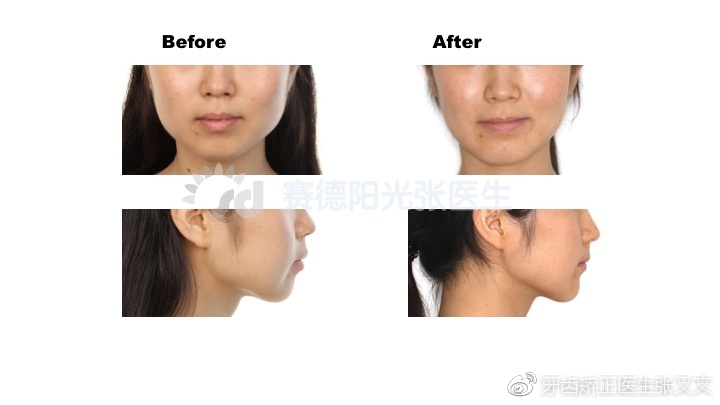 牙齿不齐龅牙地包天牙齿矫正的神奇魔法