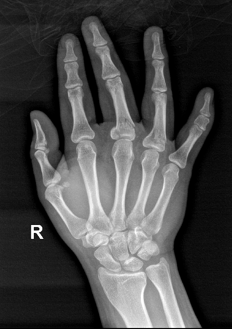 手骨折的x光片图片图片