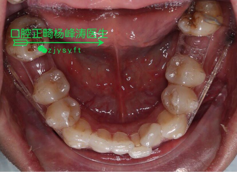 支抗钉配合隐形矫正磨牙后推