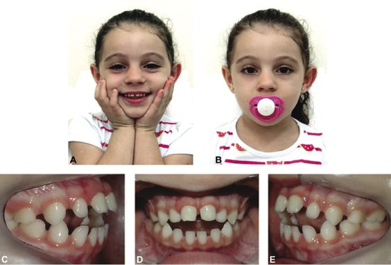 牙齿发育畸形图片