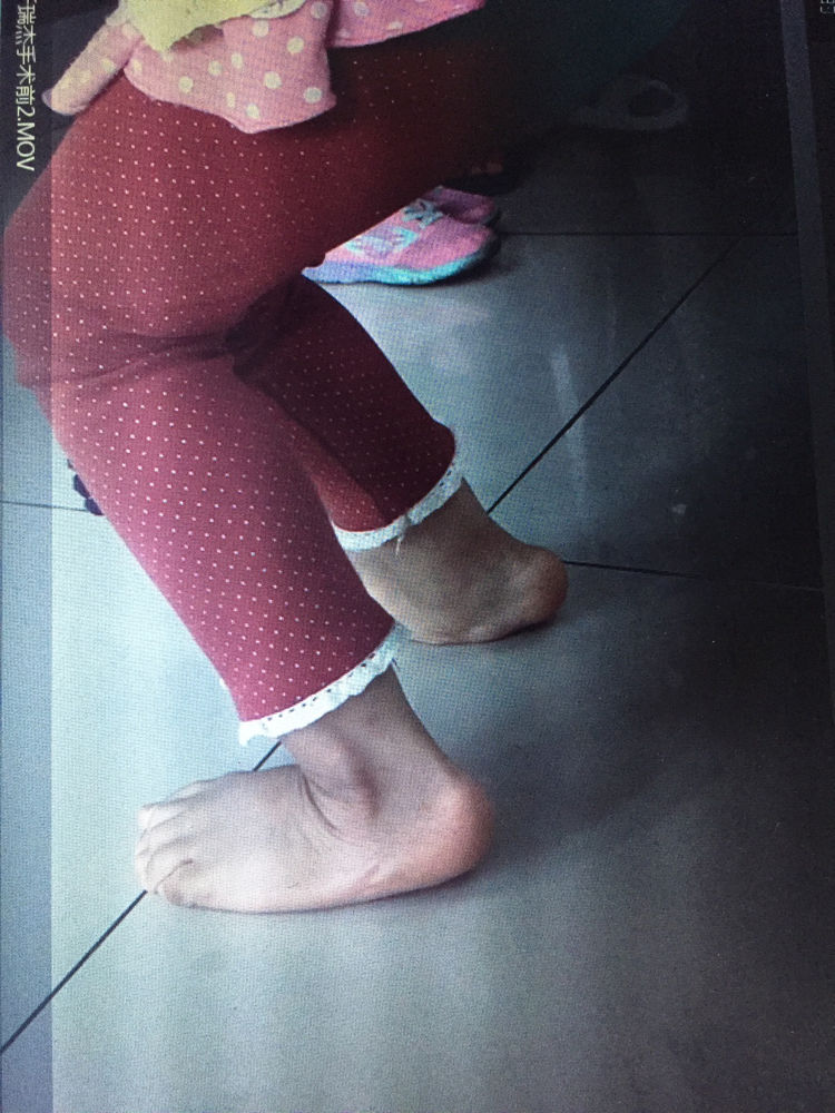 伸能力増强术后2月:第一次独站,有点不适应术后2月:第一次独站,腿直了