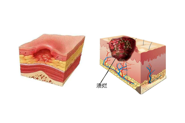 褥瘡的分期與護理方法,傷迪最全整理!