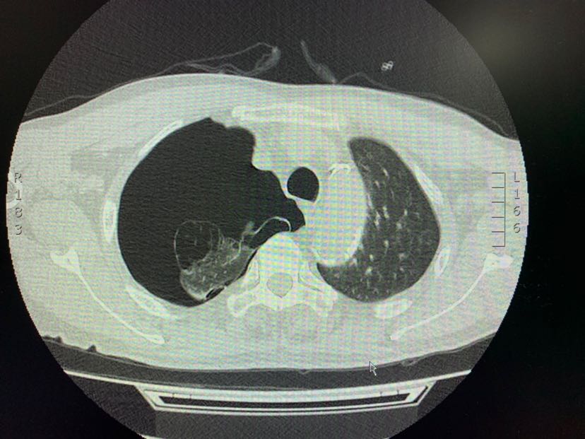 肺大疱影像图片