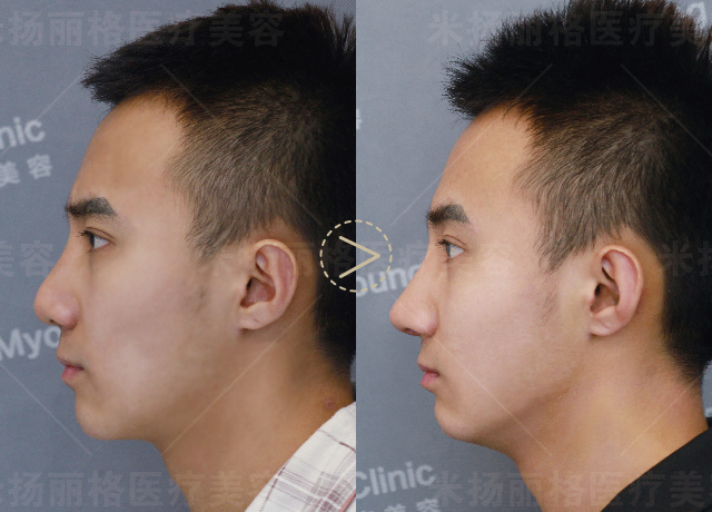 为什么越来越多的男性隆鼻