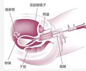 輸卵管不通的治療方法