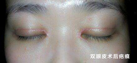 张主任,我做完双眼皮留下的疤痕能做好吗?