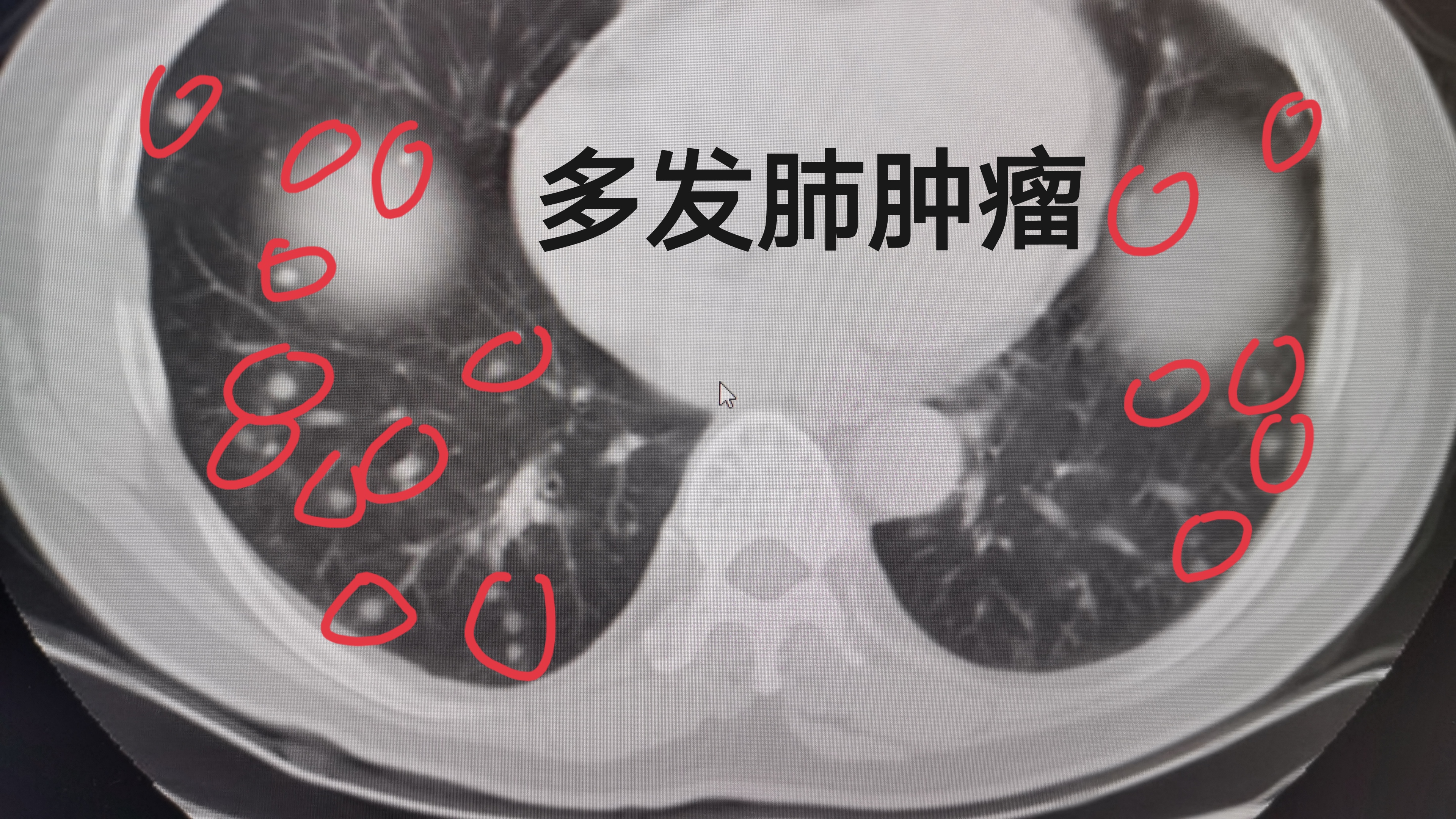 多发的肺肿瘤,是不是就是晚期肺癌?