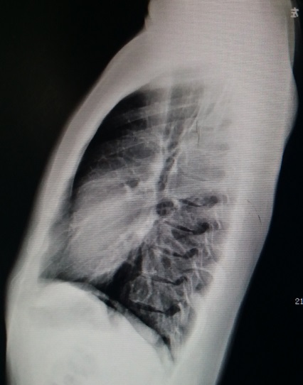 肥胖漏斗胸患者的nuss手术