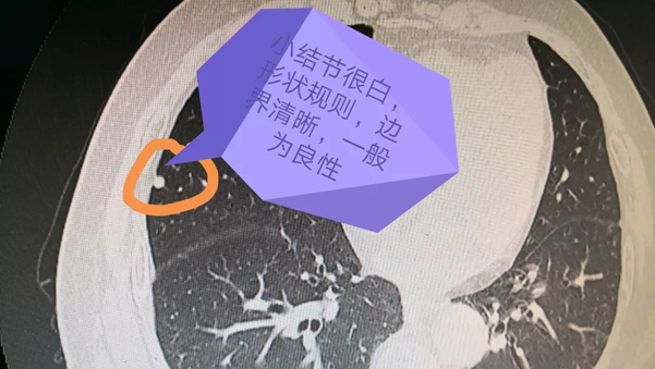 发现肺结节怎么办,读完这篇文章,你就不慌了